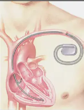 細數心臟起搏器和ICD之間的差異 細數心臟起搏器和ICD之間的差異