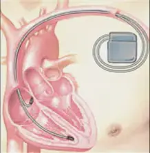 細數心臟起搏器和ICD之間的差異 細數心臟起搏器和ICD之間的差異